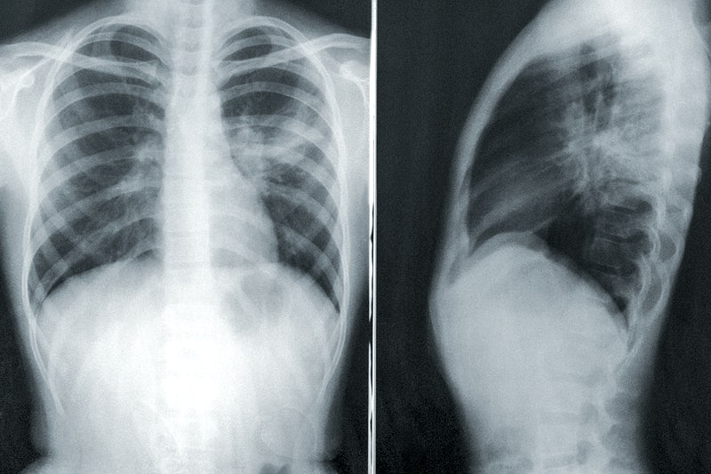 COVID-19 can lead to serious respiratory problems.