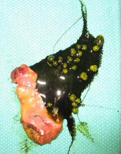 Gallbladder and contents