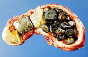http://upload.wikimedia.org/wikipedia/commons/e/e4/Gallstones.jpg alt