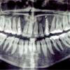 Entnommen von http://www.tapparo.com/ENG/disurbi_dente.php
